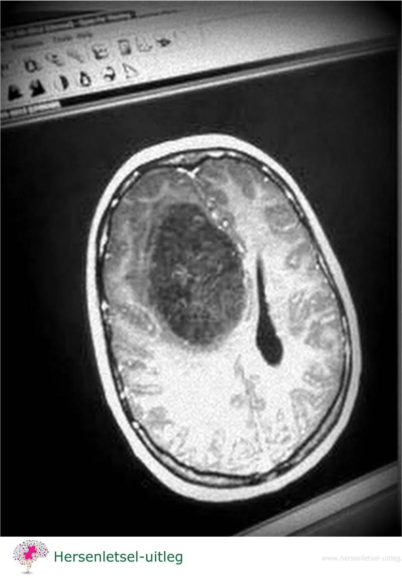 brain-tumor-standard.png