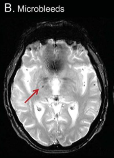 Micro Infarction Brain Small Vessel Disease / Cerebral Infarction / Stroke - CVA / Types of ...