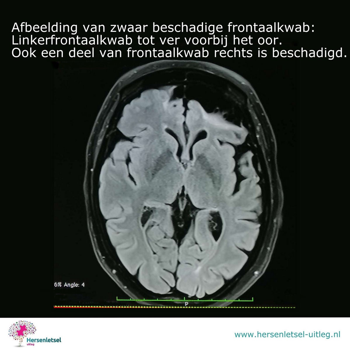 Hersen Scan Muts Hersenscans uitgelegd / Achtergrondinformatie | Hersenletsel-uitleg.nl