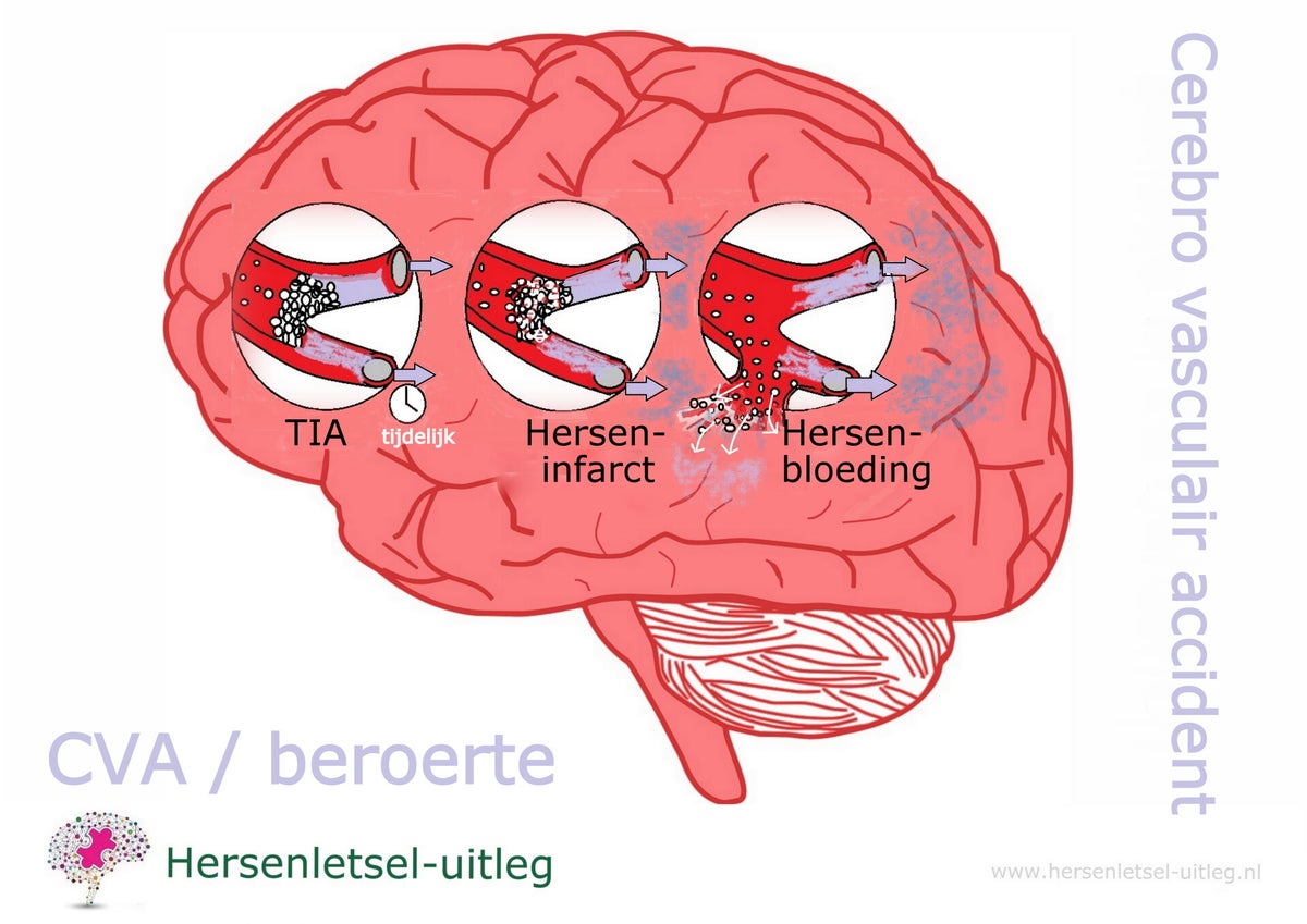 Beroerte, CVA | Hersenletsel-uitleg.nl Beroerte, Cva | Hersenletsel-Uitleg.Nl