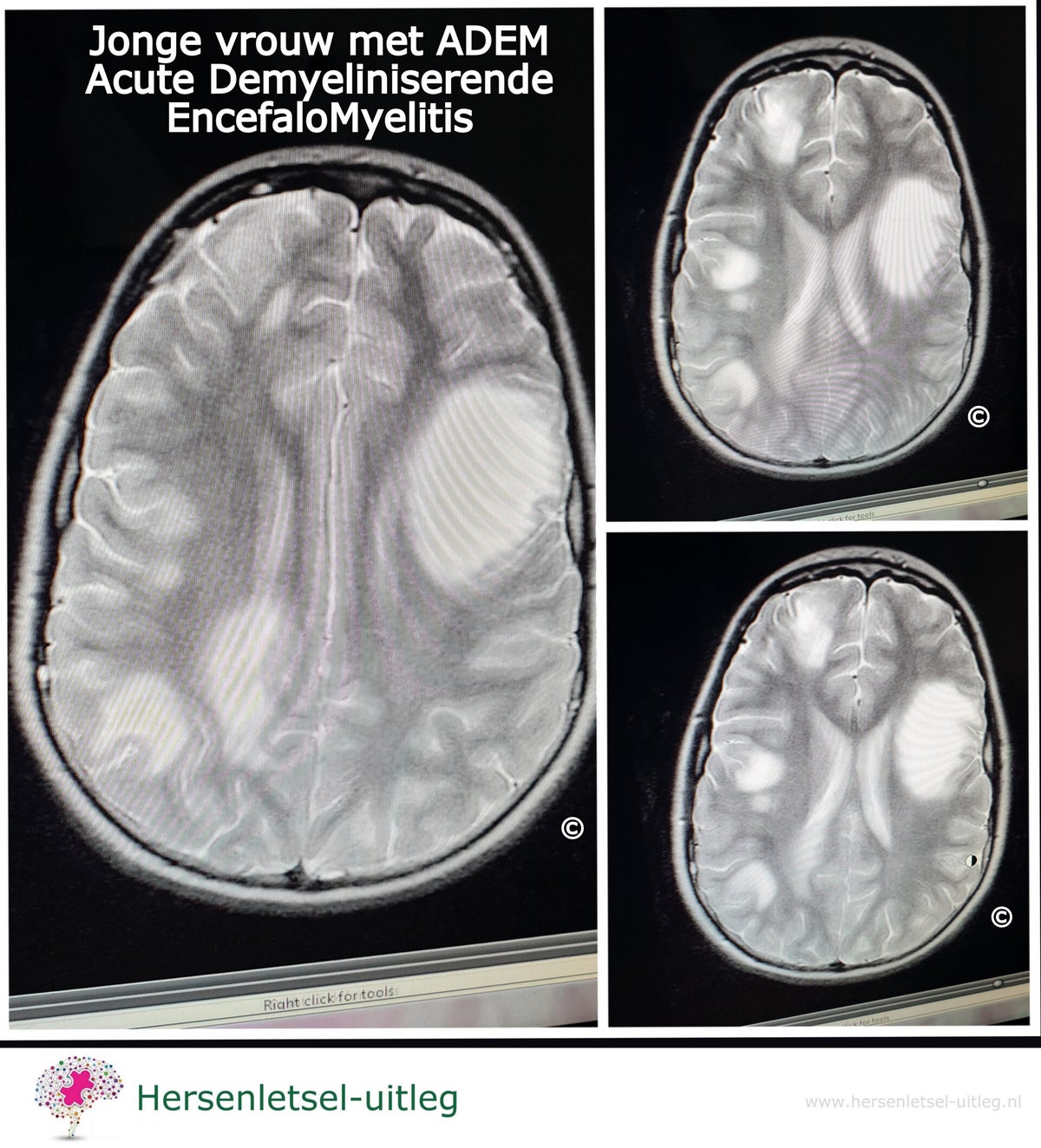 ADEM Acute Demyeliniserende EncefaloMyelitis / Infecties oorzaak ...