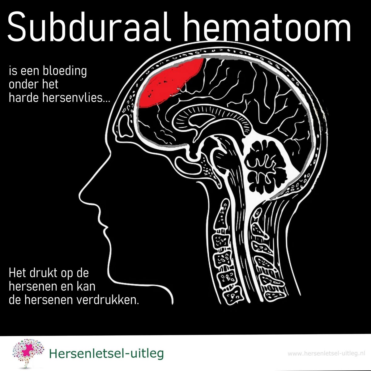 Subdurale Bloeding Subduraal Hematoom Hersenletsel Door Beroerte subdurale-bloeding-subduraal-hematoom-hersenletsel-door-beroerte