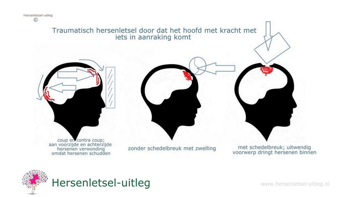 Traumatisch hersenletsel / Soorten hersenletsel hersenaandoeningen