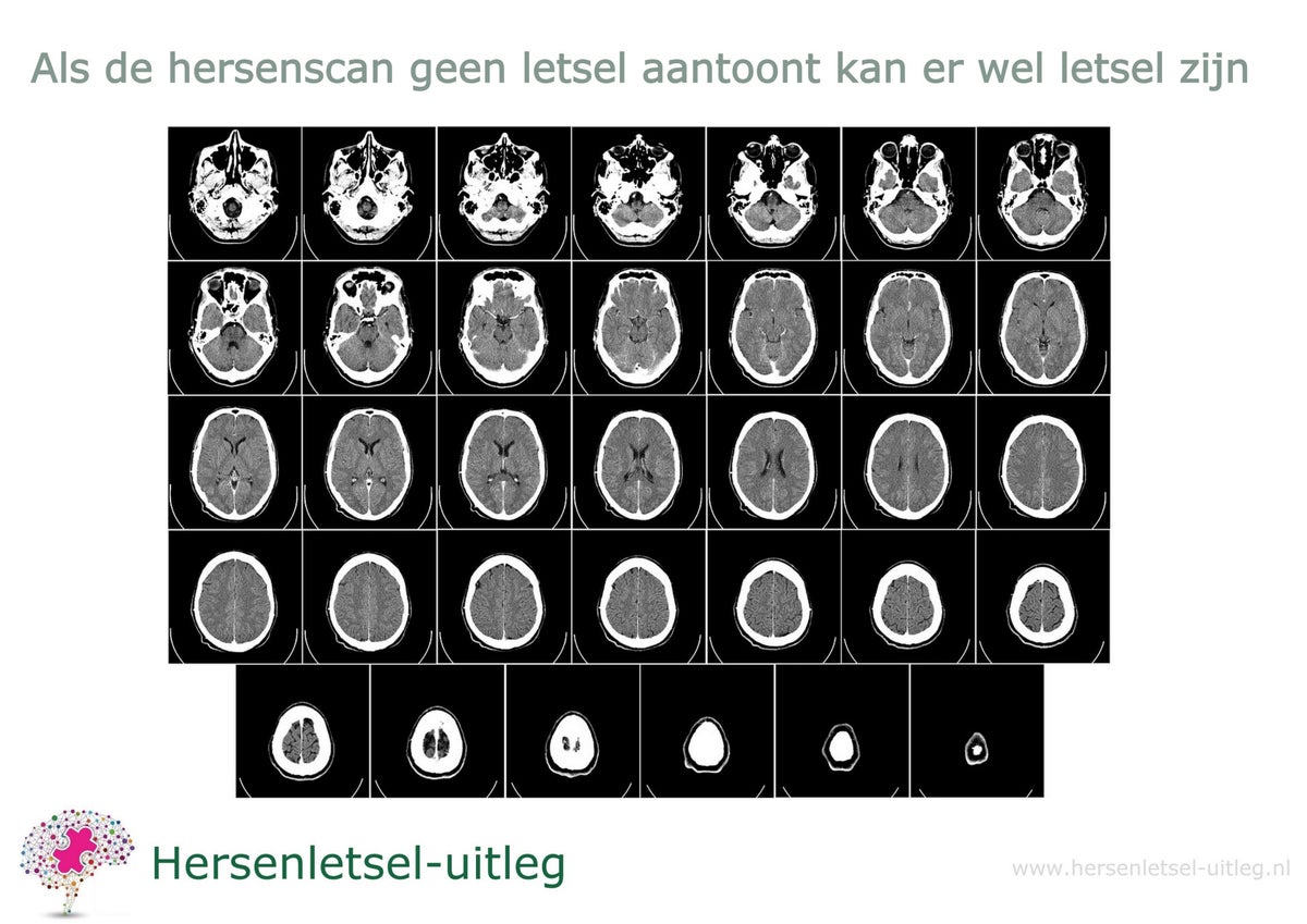 Hersenscans uitgelegd / Achtergrondinformatie | Hersenletsel-uitleg.nl