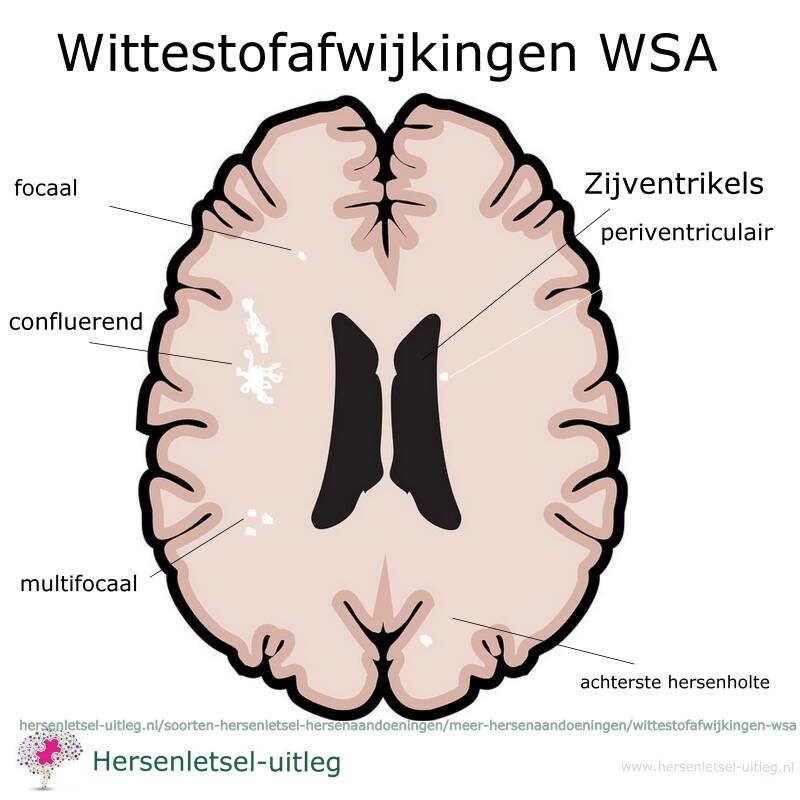 Wittestofafwijkingen WSA / Meer hersenaandoeningen / Soorten hersenletsel hersenaandoeningen