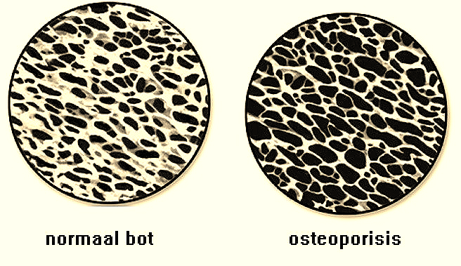 osteoporose