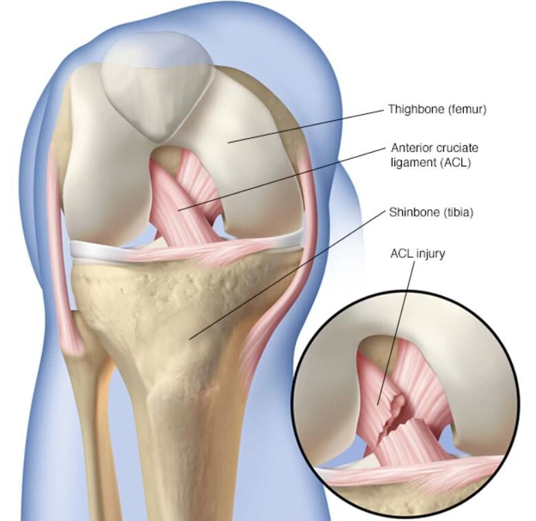 Esquinços i lesions lligamentoses