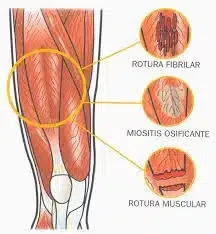 Ruptures fibril·lars i musculars