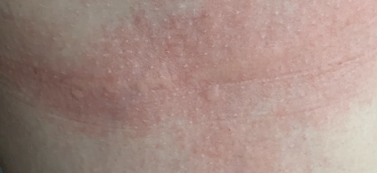 Histamine en gefermenteerde voeding