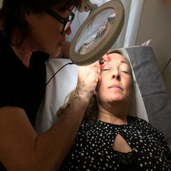 electrolysis-on-eyebrow-1-standard.jpg