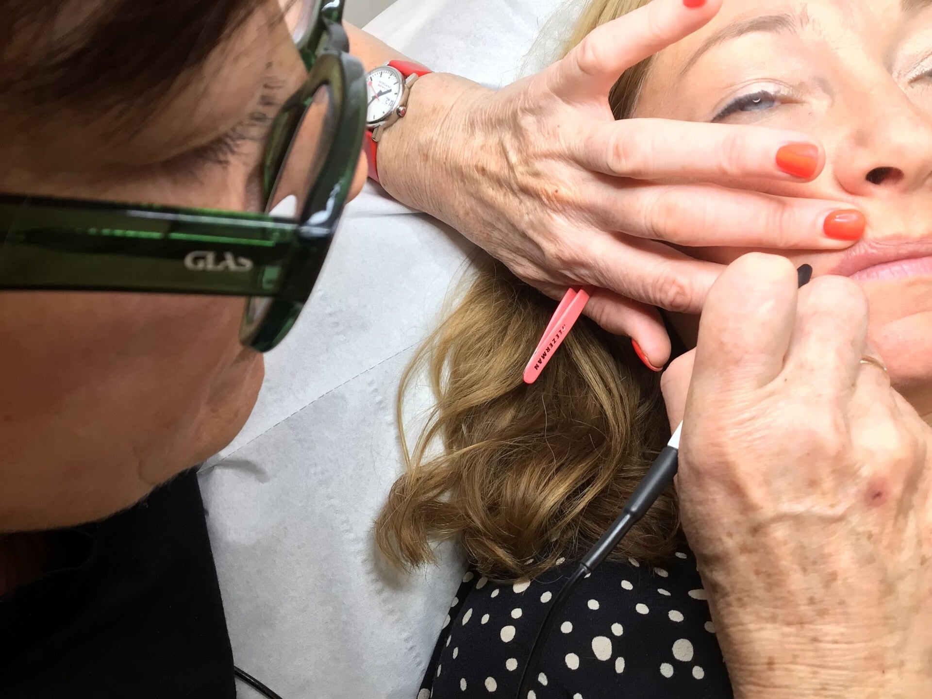 Electrolysis on chin