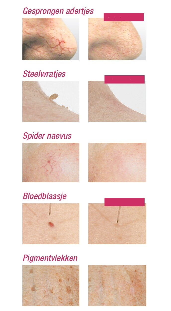 gesprongen adertjes, steelwratjes, fibromen behandelen, bloedblaasjes pigmentvlekken