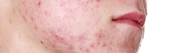 Acnebehandeling, Jeugdpuistjes, huidontstekingen, acne