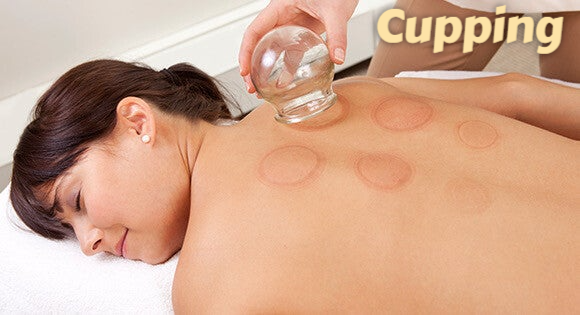 Cupping