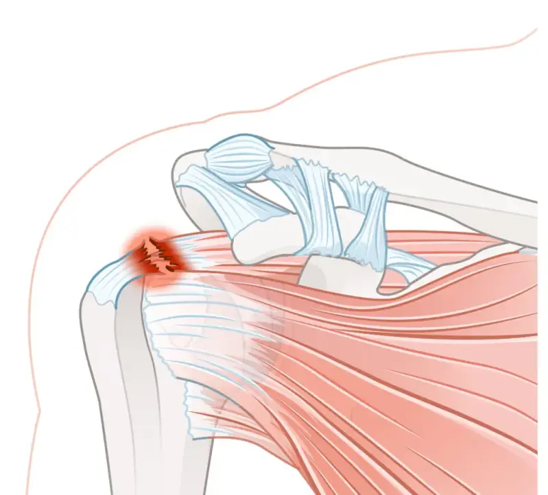 rotator-cuff-tear-standard-o4jhoh.webp