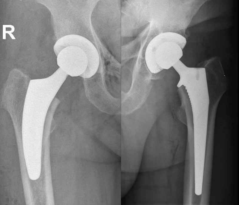 Totale Heupprothese Heup Specialisaties Orthopedie Geel totale-heupprothese-heup-specialisaties-orthopedie-geel