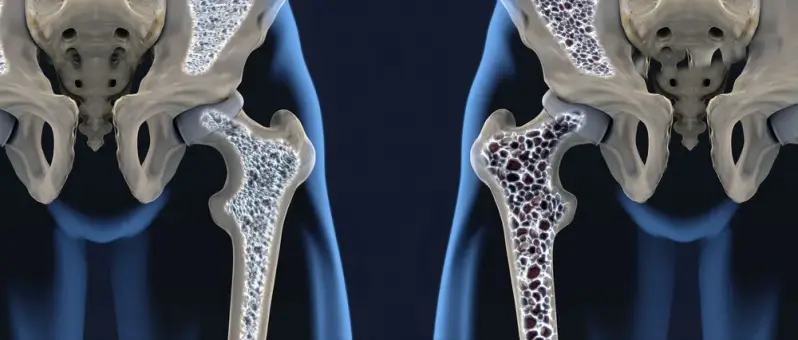 Cómo prevenir la osteoporosis   cómo prevenir la osteoporosis, salud ósea, vitamina D, calcio, ejercicio, dieta saludable, prevención osteoporosis.