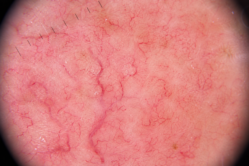 Erweiterte Gefäße, Couperose und Teleangiektasien im ersten Stadium der Rosacea
