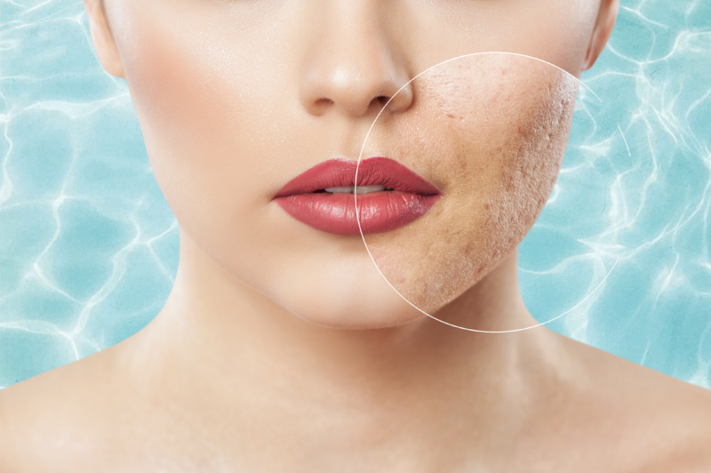 Acne vulgaris in der Vitalpraxis Peter in Gera behandeln