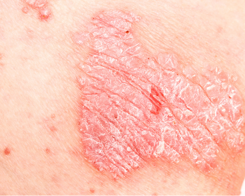 Nahaufnahme einer Psoriasis-Plaque mit silbrig-weißer Schuppung