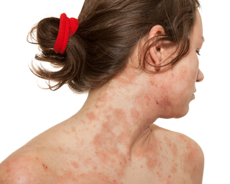 Erwachsene zeigen die Neurodermitis bevorzugt mit Ekzemen im Hals- und Dekolleté-Bereich -  jetzt ganzheitlich dermatologisch behandeln lassen in der Vitalpraxis