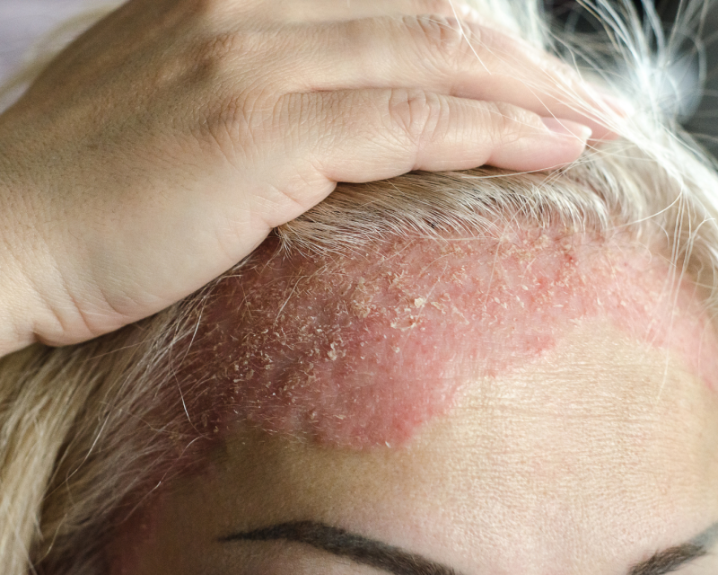 Psoriasis capitis mit schuppenden Hautveränderungen an der Kopfhaut