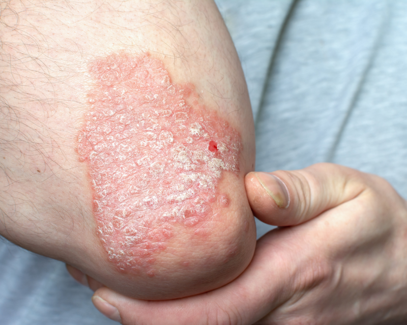 Psoriasis vulgaris am Ellenbogen mit typischen schuppenden Plaques