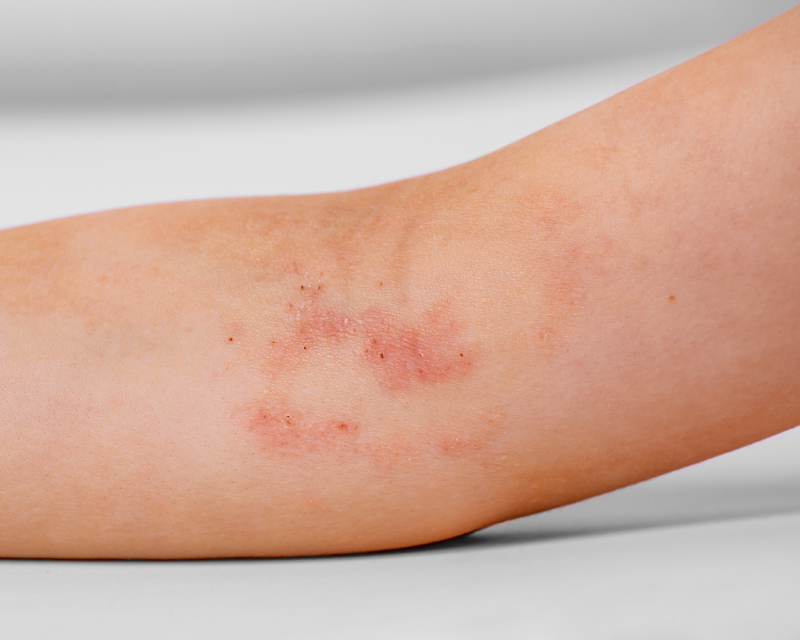 Neurodermitis ist eine komplexe Hauterkrankung, welche in der Vitalpraxis ganzheitlich betrachtet und dermatologisch behandelt wird