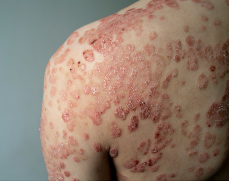 Psoriasis guttata mit zahlreichen kleinen schuppenden Hautveränderungen am Rücken