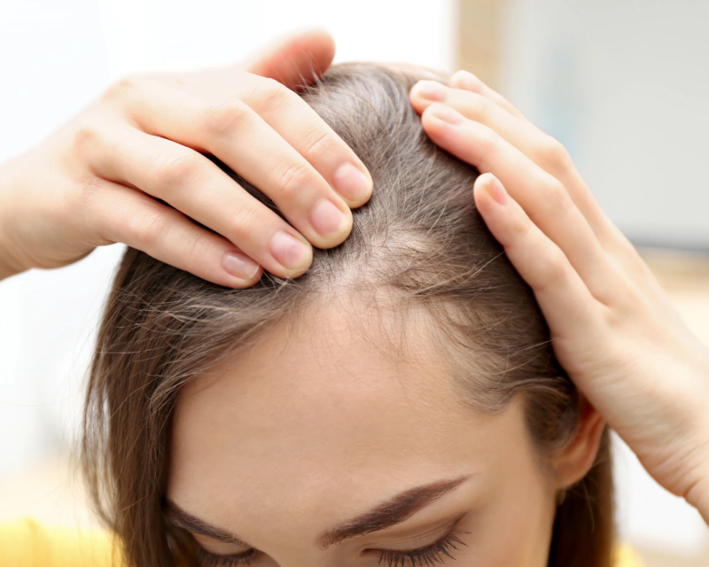 Haarausfall ist ein häufiges Symptom bei Biotinmangel