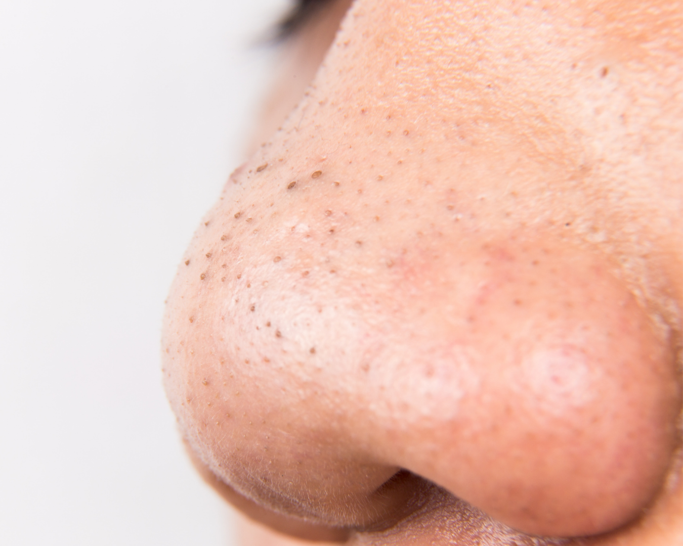 Acne comedonica