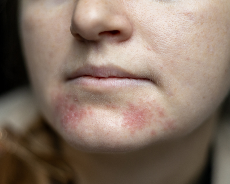periorale Dermatitis - in der Vitalpraxis behandeln lassen