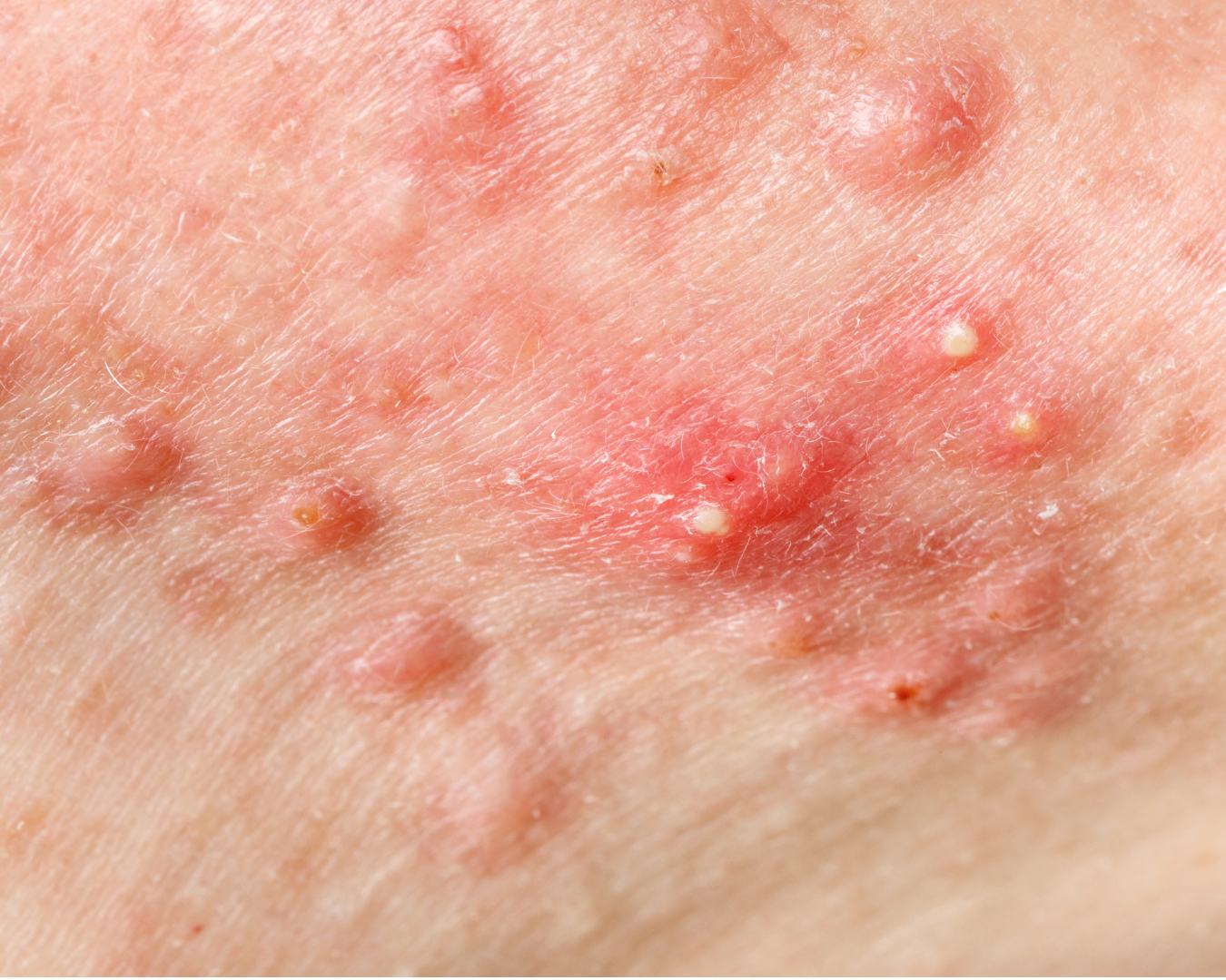 Acne papulopustulosa