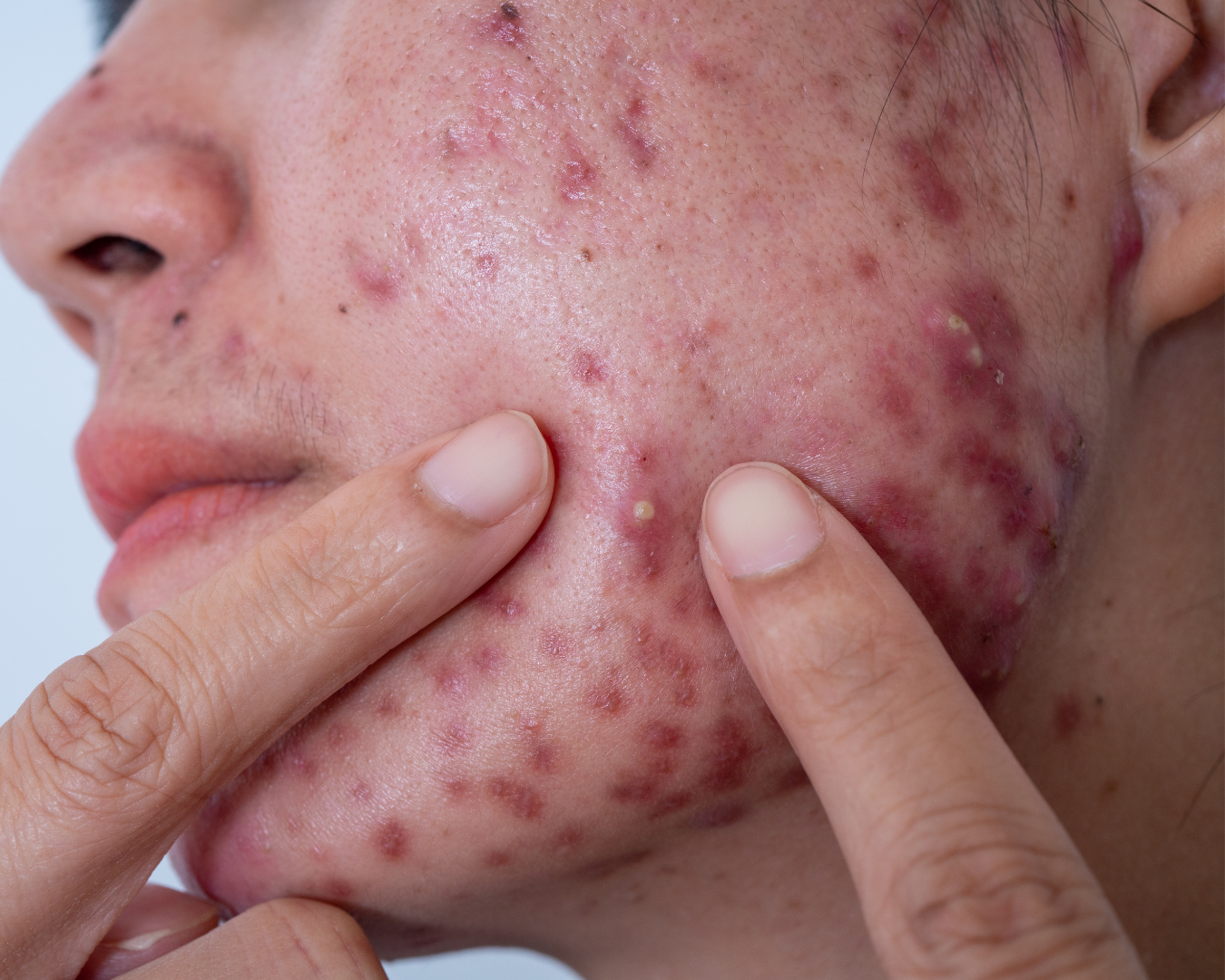 Acne conglobata