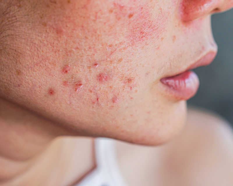 Diese Frau leidet an Pusteln und Hautentzündungen durch eine periorale Dermatitis, nachdem sie ihre Haut mit falscher Kosmetika überpflegt hat. Auch diese Hautprobleme können in der Vitalpraxis in Gera ganzheitlich behandelt werden.