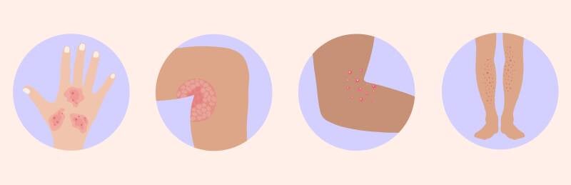 Кожни обриви