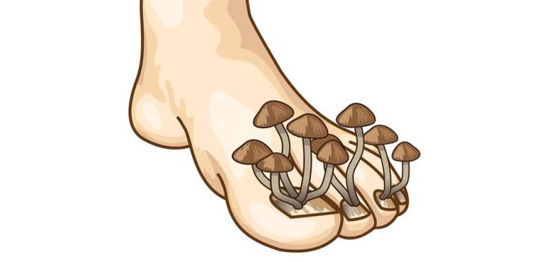 Атлетично стъпало (гъбична инфекция на стъпалото)
