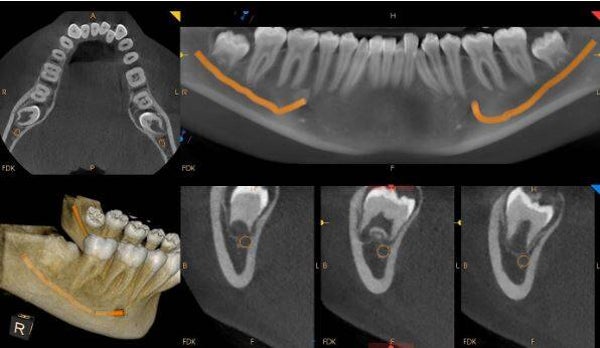 Medium F.O.V CBCT