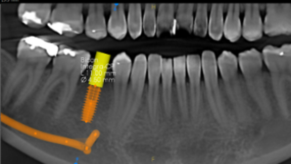 Implant planning