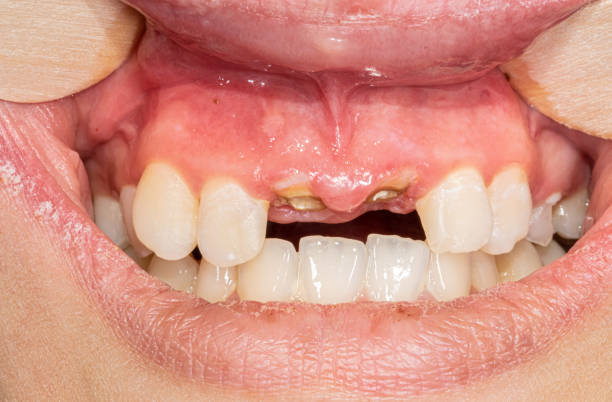 Root fracture or failed root canal