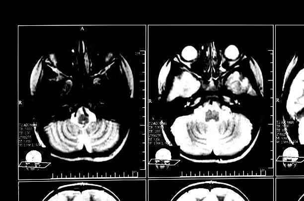 How to Read TMJ MRI