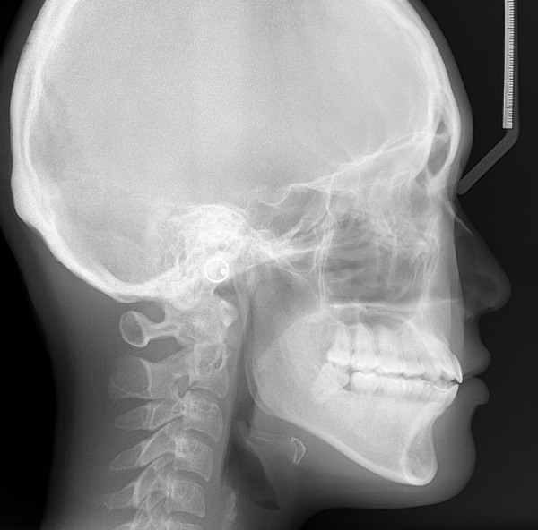 Lateral Cephalometric image