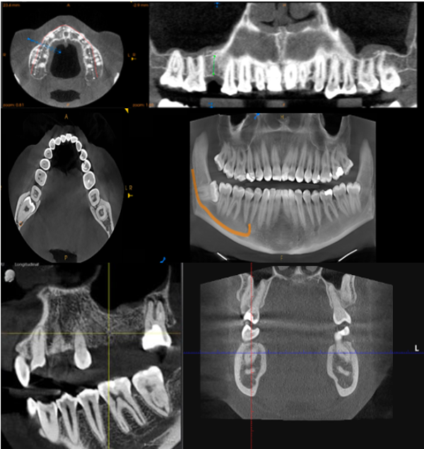 Medium F.O.V CBCT