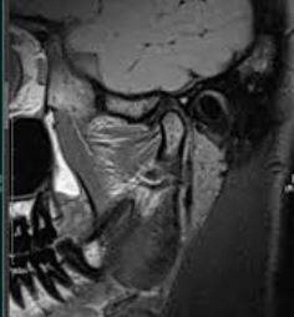 TMJ MRI
