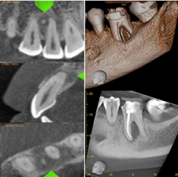 small or Limited Field CBCT
