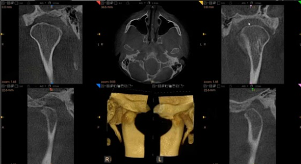 TMJs CBCT