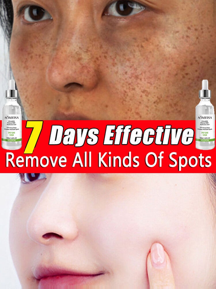 Anti spot Remove freckles, chloasma, dark spots, hyperpigmentation,