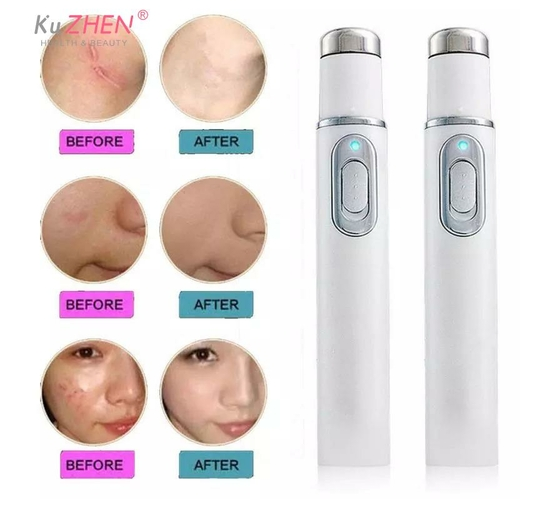 ACCHINGE Acne Wrinkle Removal Laser Pen Skin Spots Removal Anti Varicose Spider