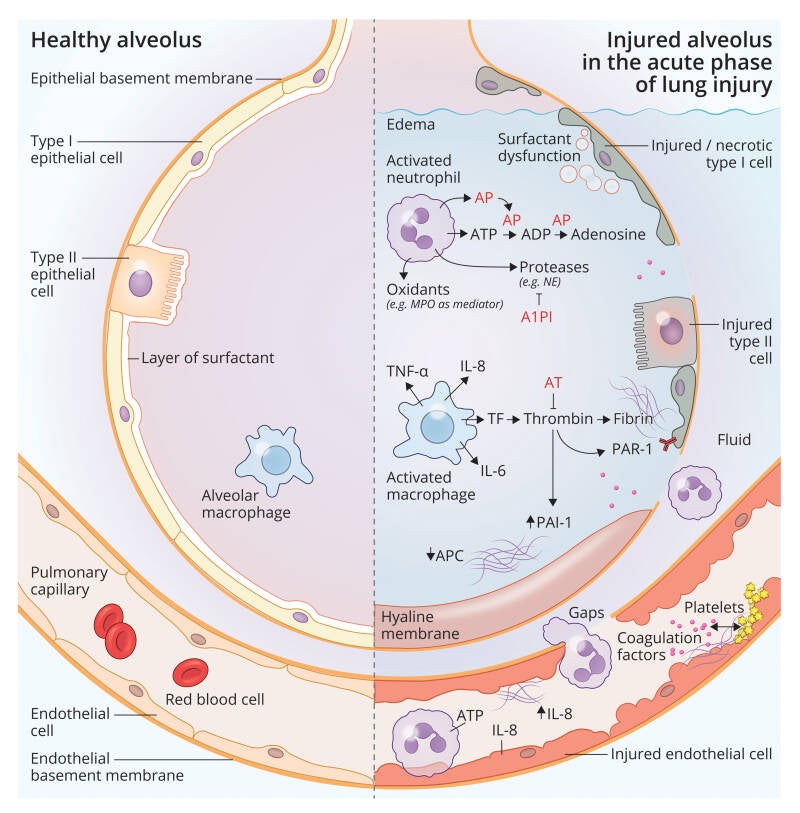 wetenschappelijke illustratie van gezonde alveolus en beschadigde alveolus