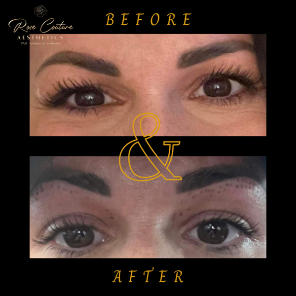 Plasma fibroblast treatment (Plasma pen)